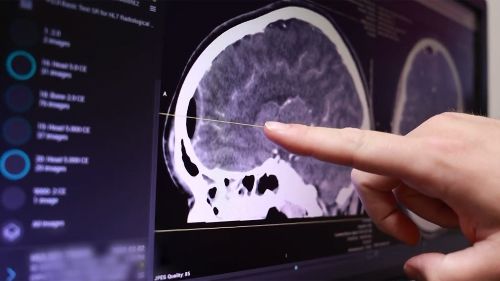 finger pointing to a brain tumor on a brain image scan