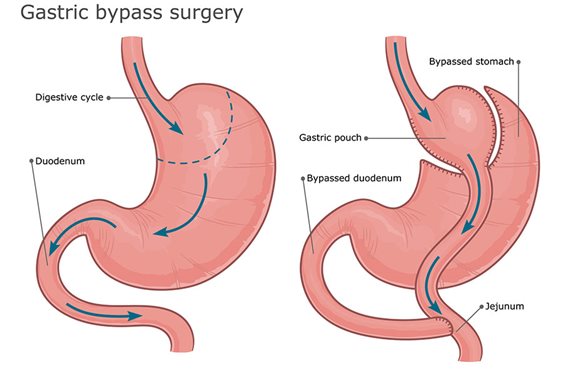 Bariatric Gastric Bypass