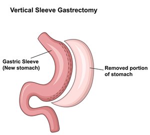 Bariatric Sleeve Gastrectomy
