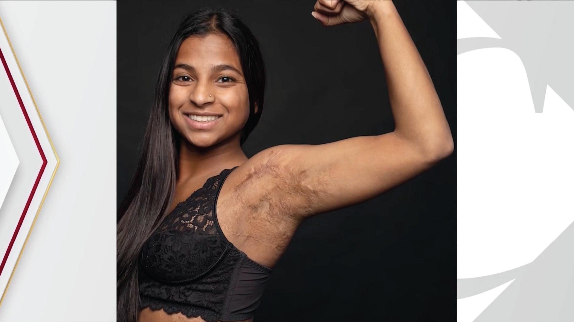 Pediatric Burn Survivor Visits Care Team