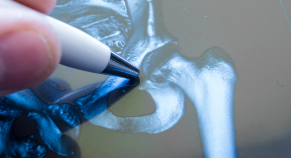 A close up of a hand using a pointer to show a hip joint in X-ray